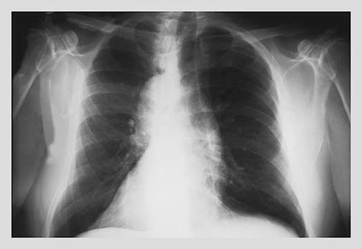 Chest- Gallery Wrapped Canvas Art 28" x 42"