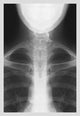 Infant Chest- Fine Art Giclee Print 24" x 36"