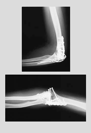 Repaired Elbow- Gallery Wrapped Canvas Art 28" x 42"